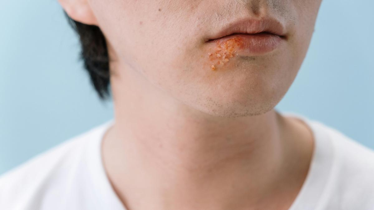 Un megaestudio asocia el herpes labial con un mayor riesgo de desarrollar alzhéimer