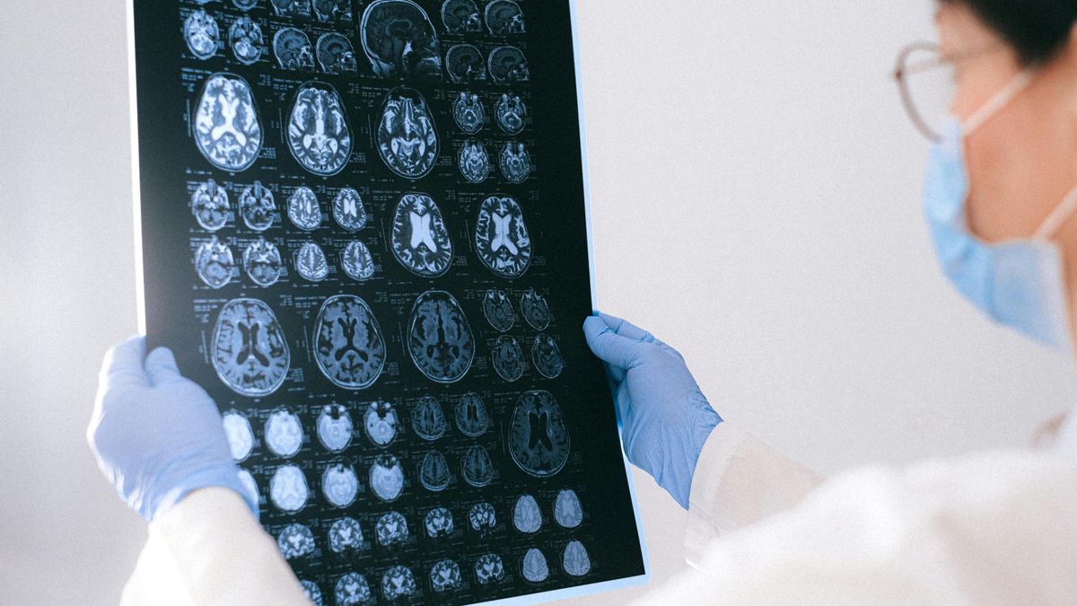 Pacientes con la enfermedad de Huntington son tratados por primera vez con éxito mediante terapia génica