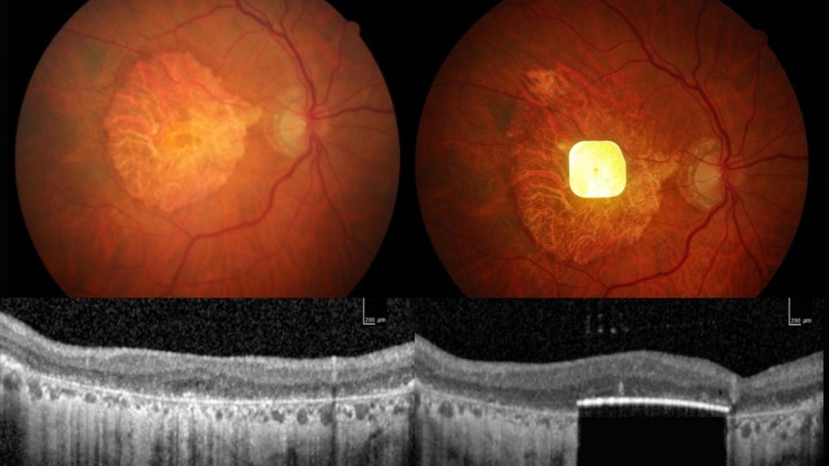 Una prótesis ocular permite leer a personas con ceguera irreversible
