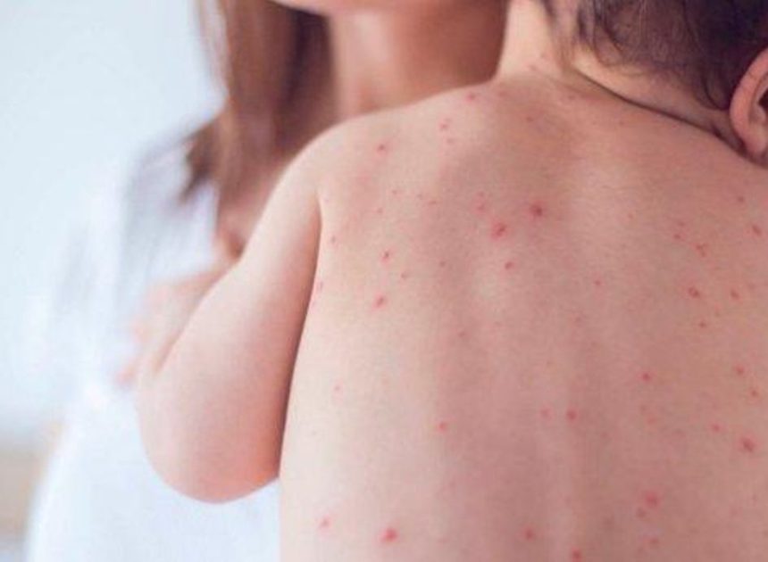 La OMS saca a España de la lista de países libres de sarampión